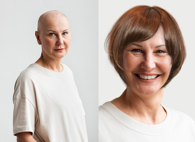female-alopecia-solution